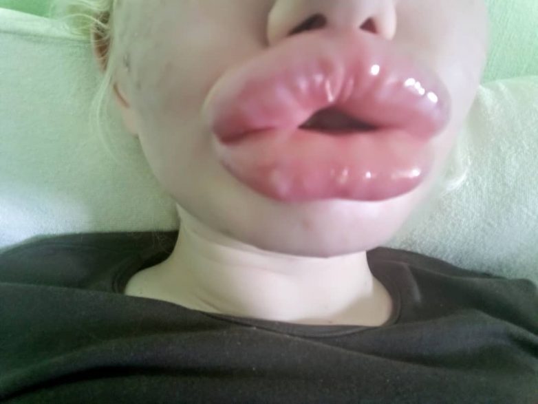 Эта болгарка с самыми большими губами в мире провела 20-ю операцию по их увеличению