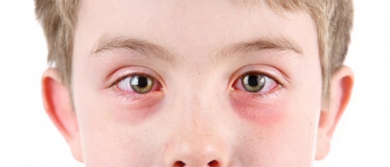 Причины и лечение синдрома красного глаза