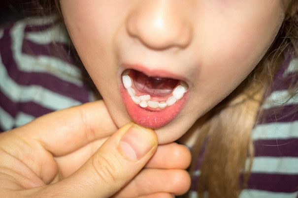 Что делать, если зубы у ребёнка растут в два ряда?