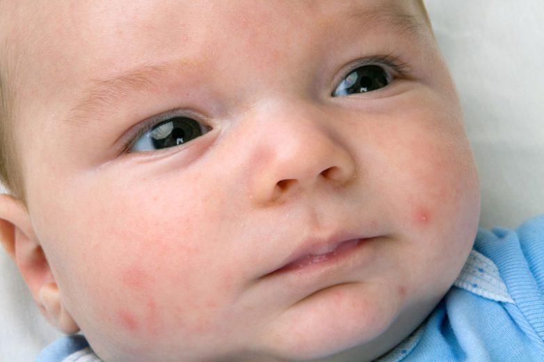 Стали известны самые распространенные болезни младенцев в России