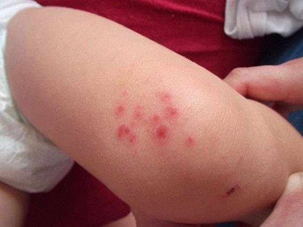 Обнаружена неожиданная причина развития аллергии у детей