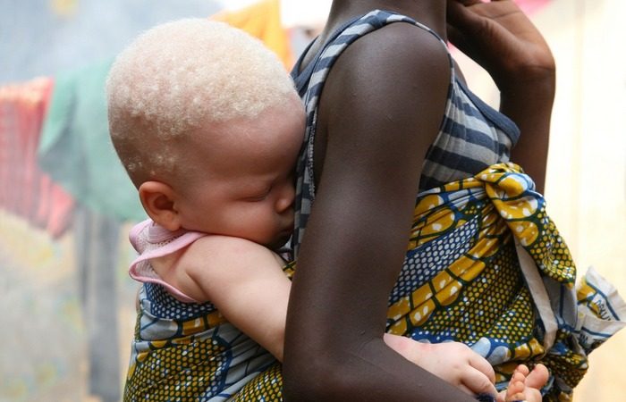 Невероятные и любопытные факты о людях-альбиносах