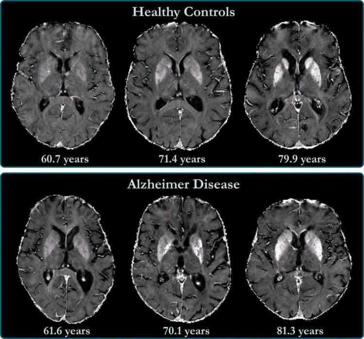 Вопрос на засыпку: болезнь Альцгеймера заразна?