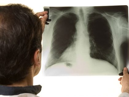 Заболеть туберкулезом может каждый. Как вовремя распознать болезнь?