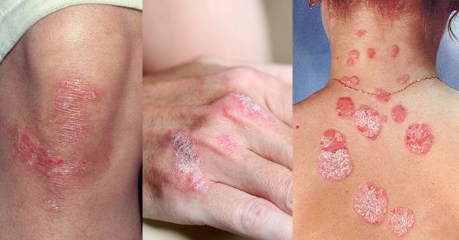 Причины покраснения и шелушения кожи