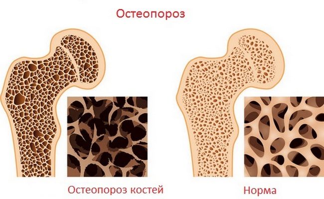 Остеопороз: факторы риска развития