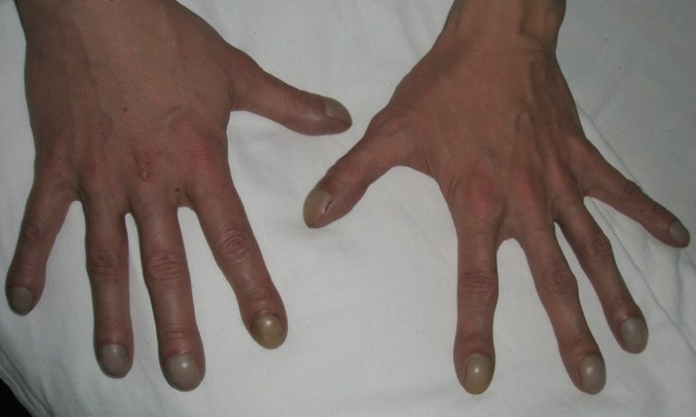 Как определить болезнь по ногтям