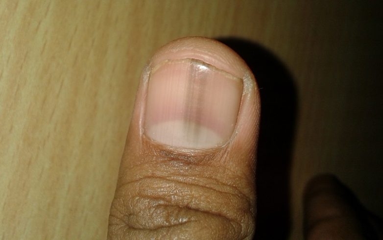Как определить болезнь по ногтям
