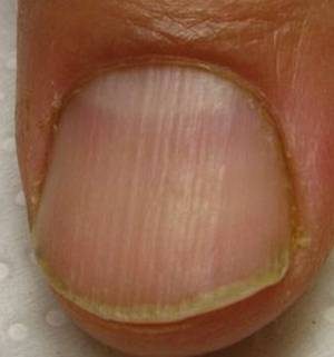 Полосы на ногтях вертикальные о чем говорят. Ониходистрофия, лейконихия. Продольная меланонихия. Ониходистрофия (дистрофия ногтей). Ониходистрофия борозды.