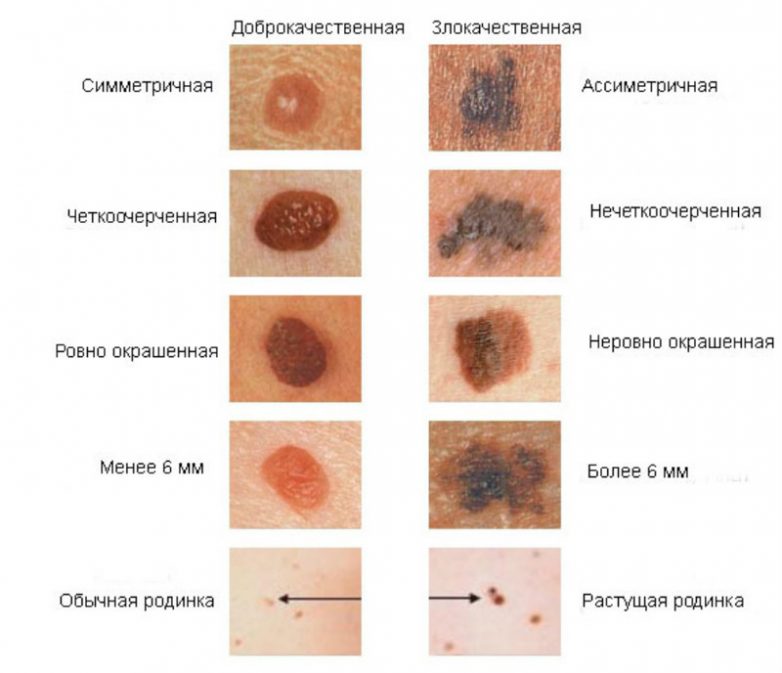 Как визуально определить рак кожи на ранней стадии?