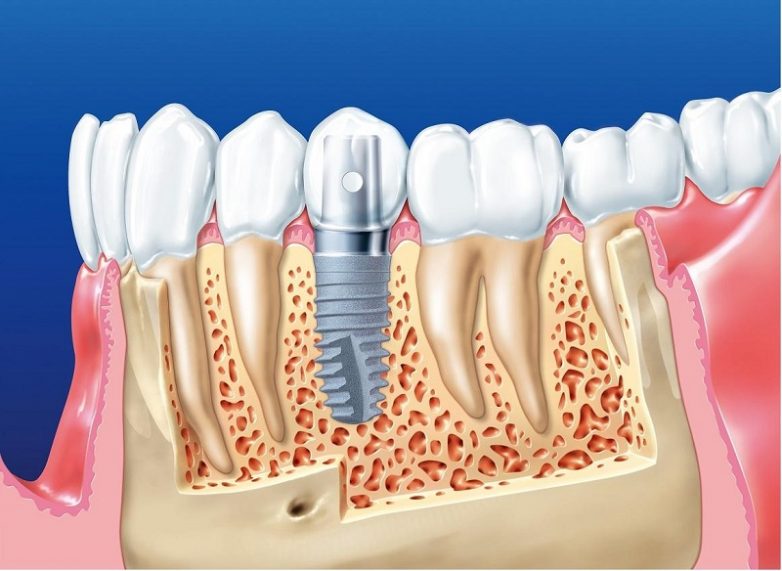 Вся правда про зубные импланты