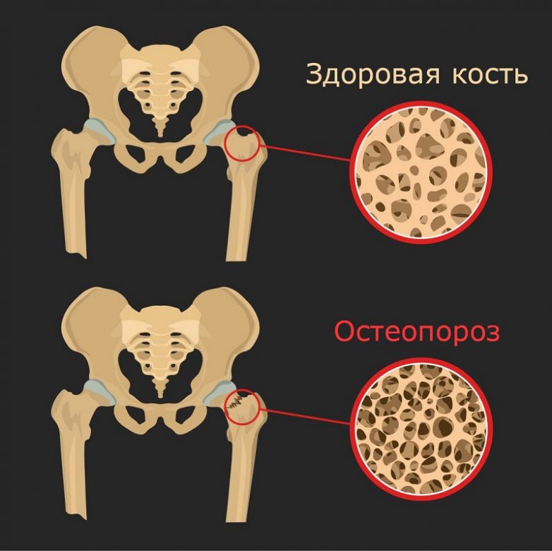 Как распознать и победить остеопороз?