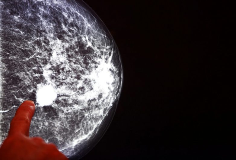 В США вылечили 49-летнюю женщину с последней стадией рака груди!