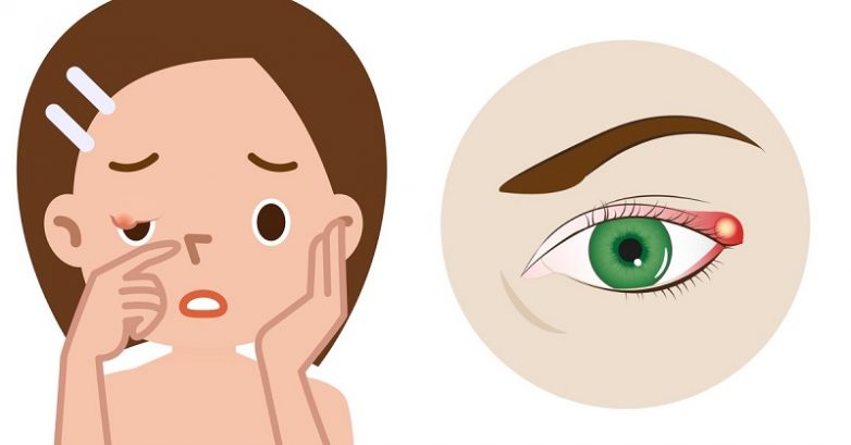 8 безопасных и эффективных способов избавиться от ячменя на глазу