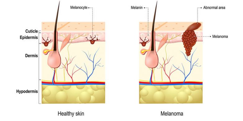 6 признаков меланомы