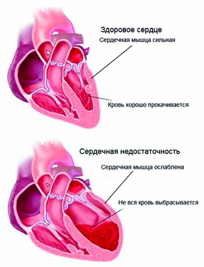 Главные симптомы сердечной недостаточности