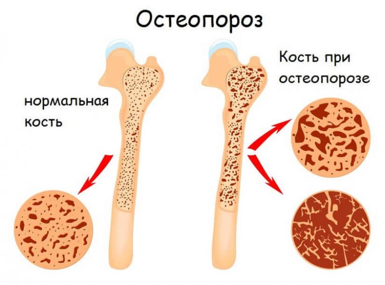 Элемент, который поможет предотвратить остеопороз