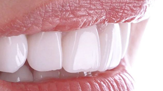 Преимущества безметалловых зубных коронок