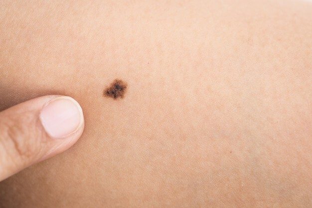 7 признаков рака кожи