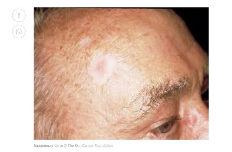 7 признаков рака кожи