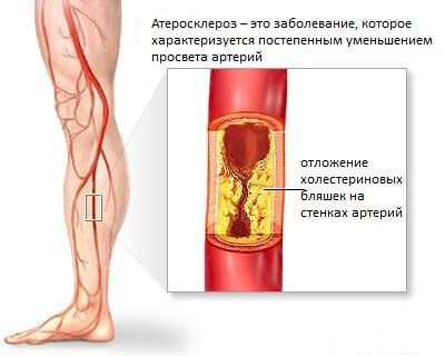 Симптомы атеросклероза сосудов ног