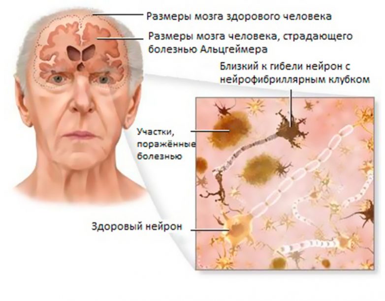 Как уберечь себя от болезни Альцгеймера