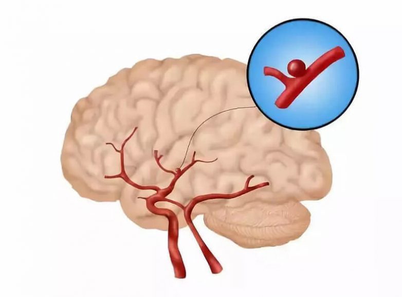 Симптомы аневризмы сосудов головного мозга