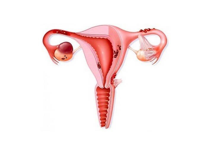 Что важно знать женщинам об эндометриозе
