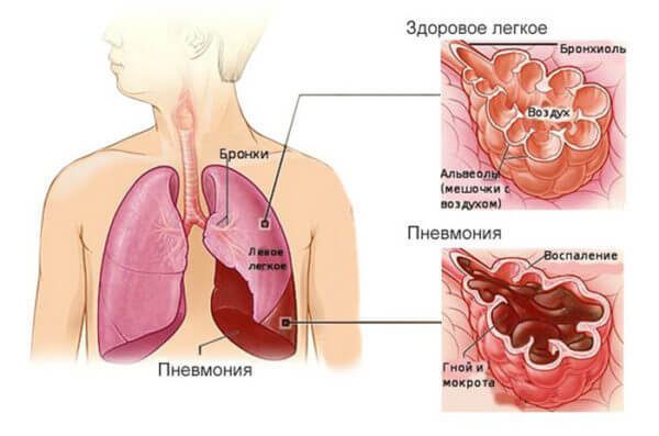 Знания, которые спасут жизнь при пневмонии у детей и взрослых