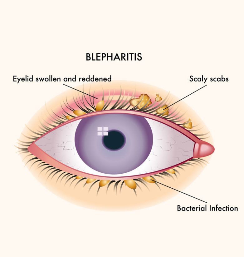Симптомы и лечение блефарита