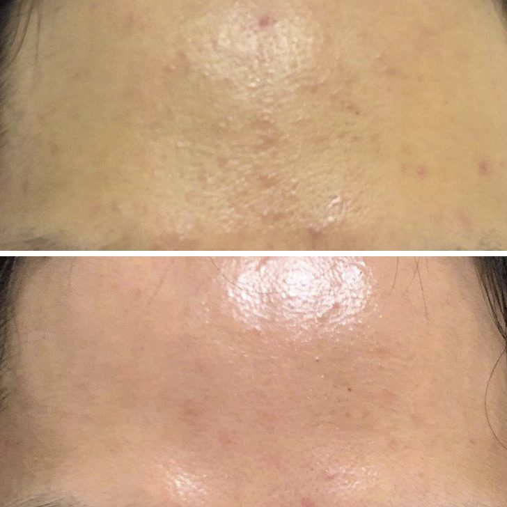 11 человек, которые добились значительных улучшений кожи лица без дорогих косметических процедур