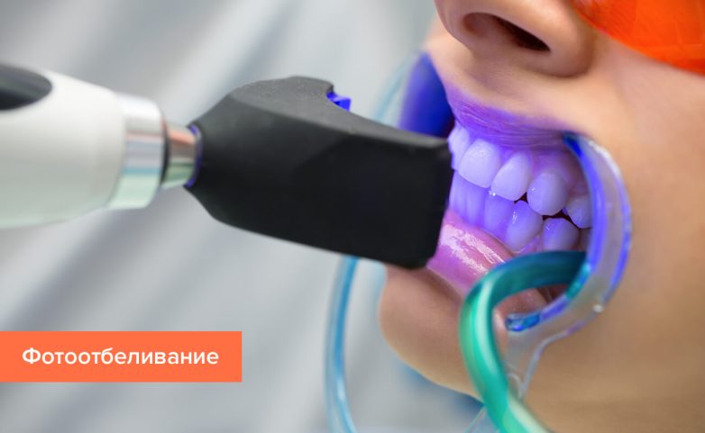 Отбеливание зубов: виды процедур, плюсы и минусы