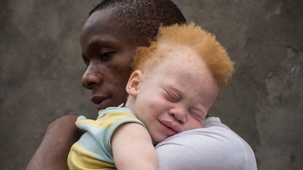 Интересные факты про альбиносов