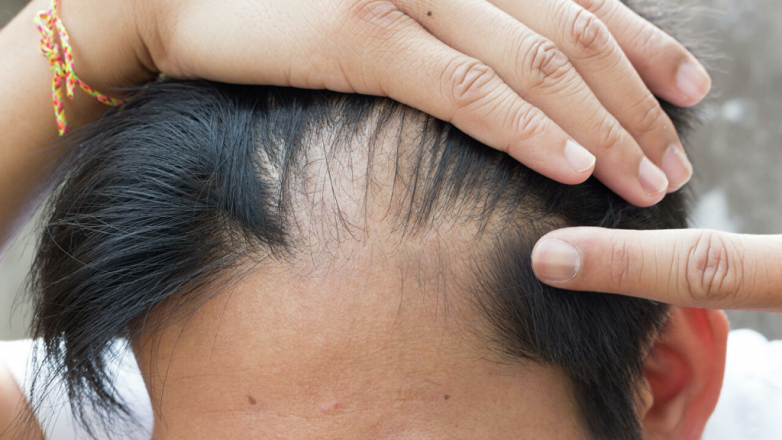 Как остановить выпадение волос после COVID-19