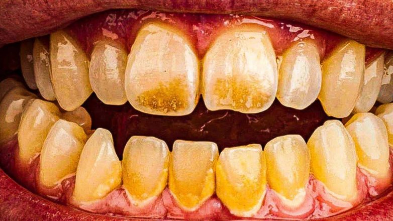На какие болезни может указать цвет налета на зубах