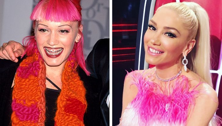 Как изменились улыбки знаменитостей после того, как они исправили свои зубы