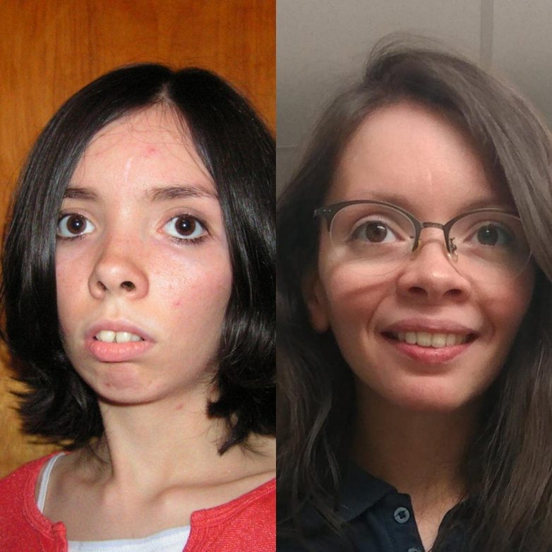 До и После. Когда люди не пожалели о том, что сделали пластическую операцию